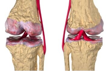 Varices de développement du gonarrose