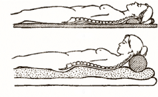 Figure d'ostéochondrose