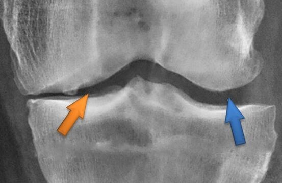 Kines Butapy pour l'arthrose
