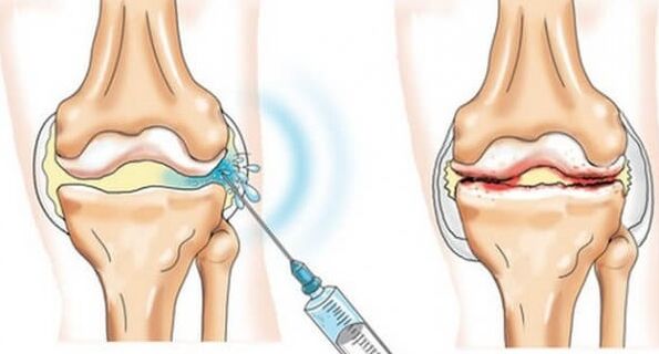 Mesures médicales pour l'arthrose